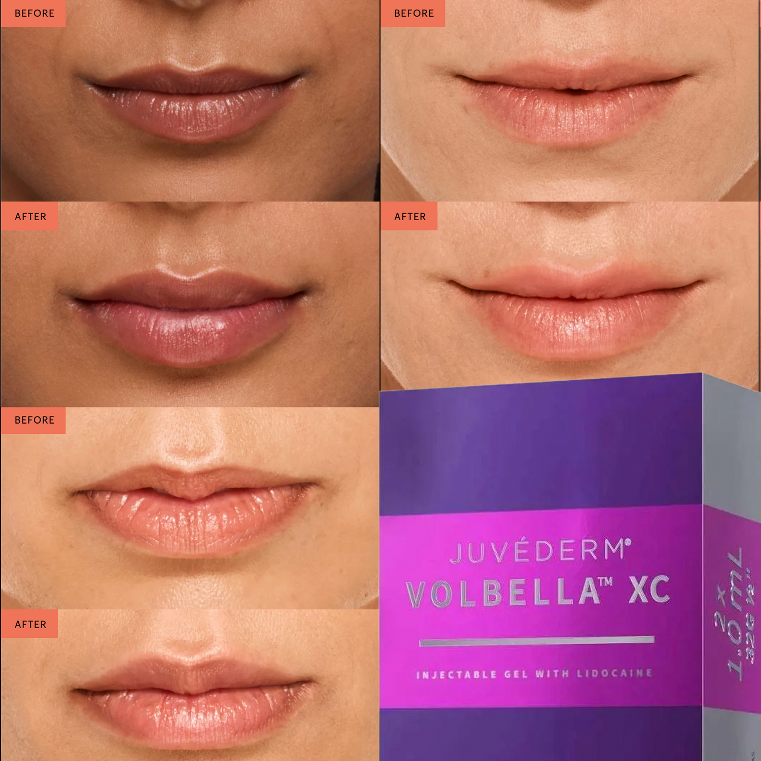Juvederm VOLBELLA XC Filler Treatment